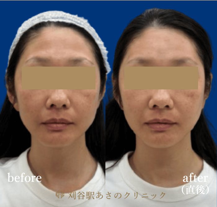 CGスタイラー 症例写真