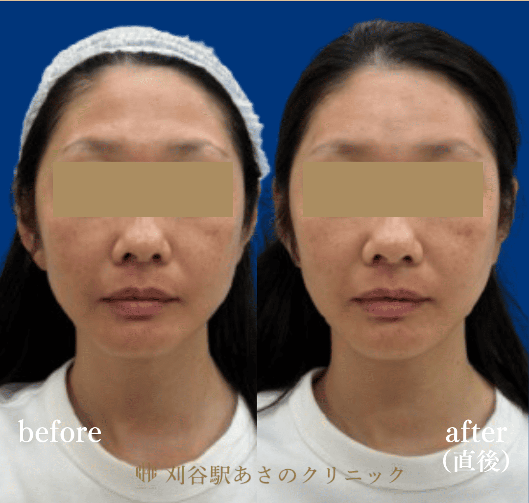 CGスタイラー 症例写真