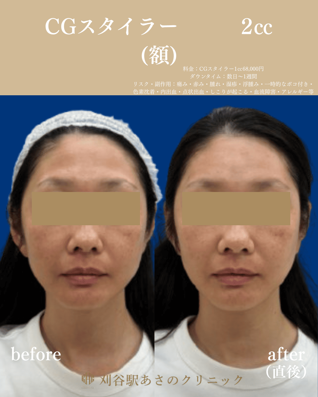 CGスタイラー 症例写真 1
