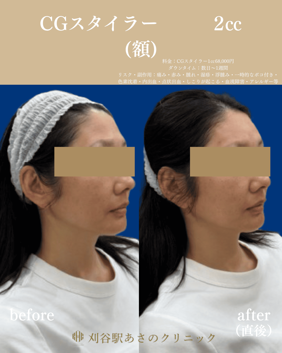CGスタイラー 症例写真 2