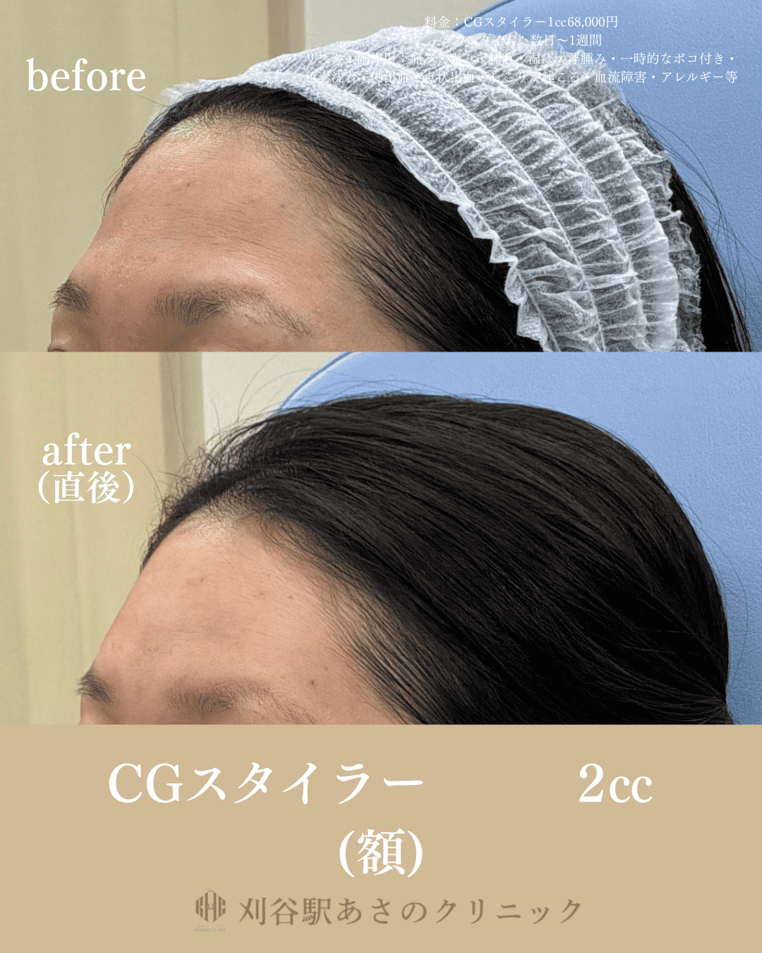 CGスタイラー 症例写真 3