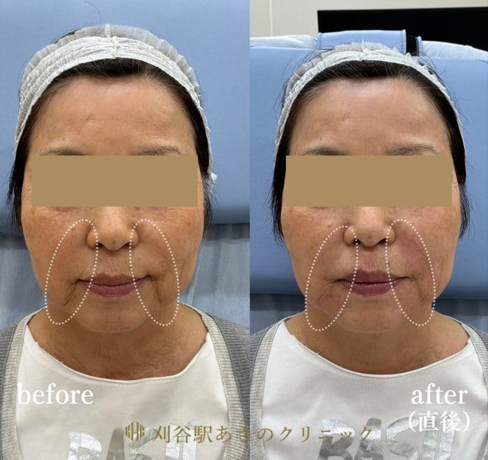 CGスタイラー 3cc 症例写真
