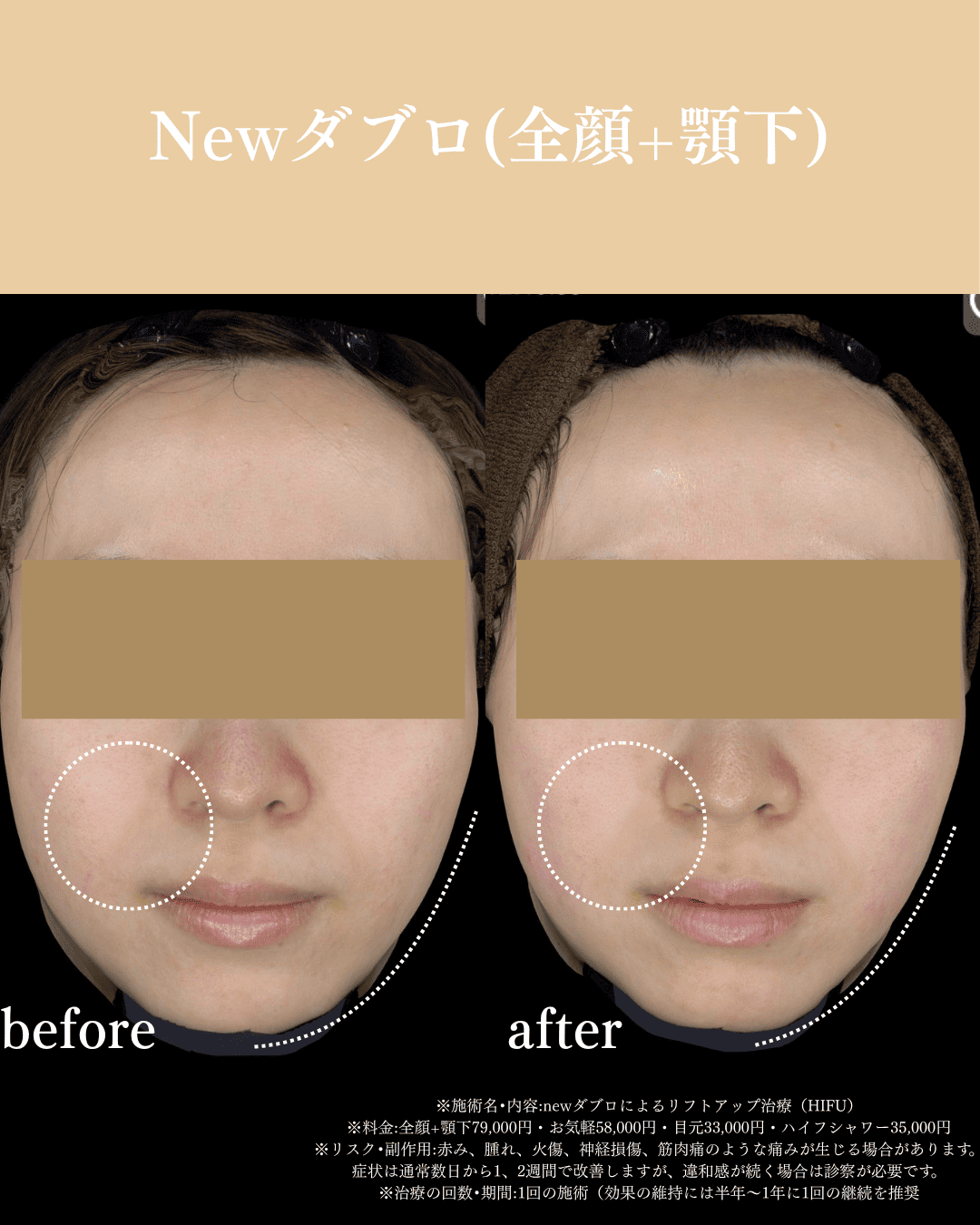 Newダブロ 症例写真 1