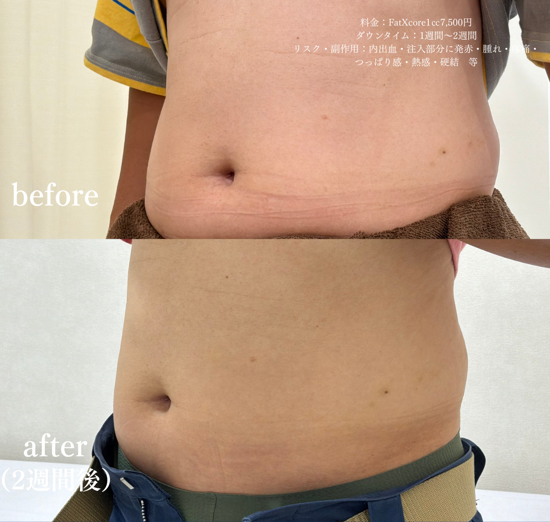 脂肪溶解注射 FatXcore 症例写真