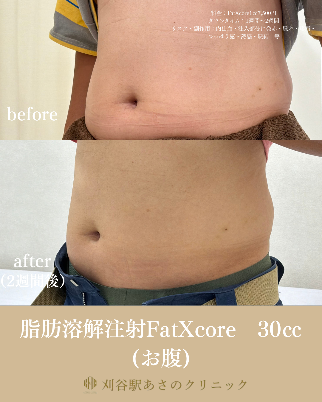 脂肪溶解注射 FatXcore 症例写真 1