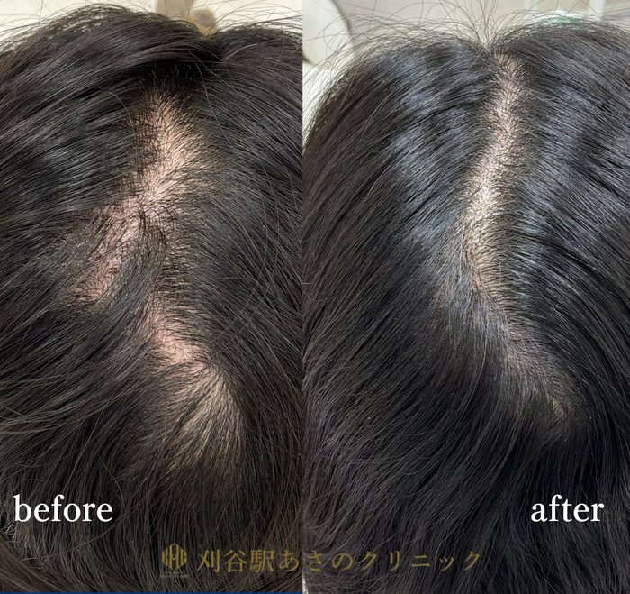 薄毛注入セラピー 症例写真