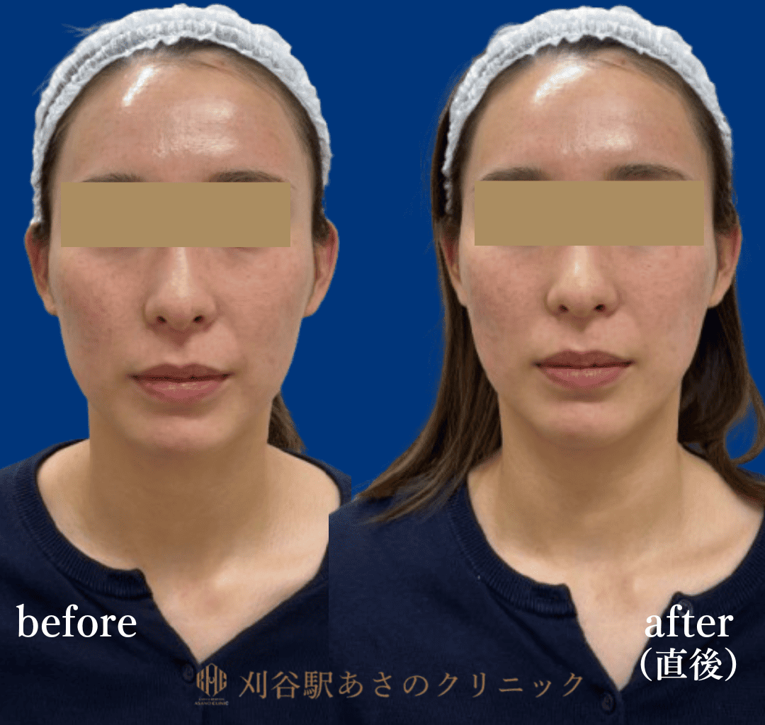 ヒアルロン酸 2cc 症例写真