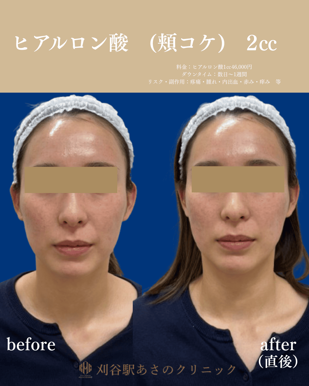 ヒアルロン酸 2cc 症例写真 1