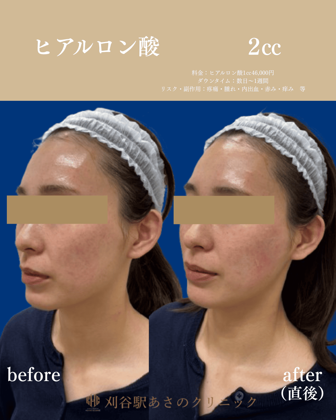 ヒアルロン酸 2cc 症例写真 2