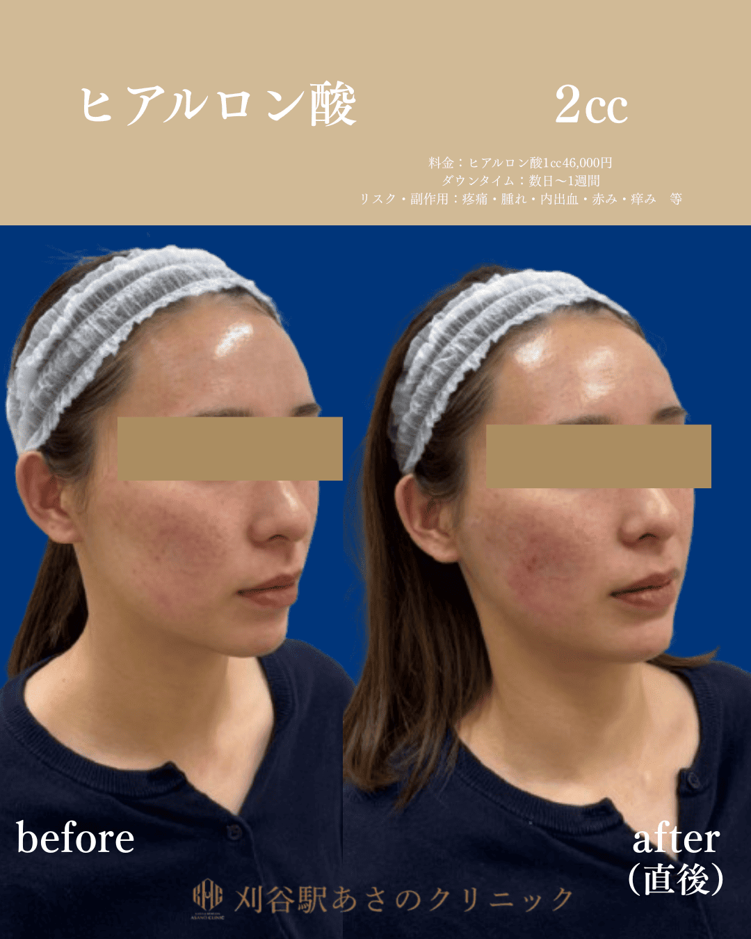 ヒアルロン酸 2cc 症例写真 3
