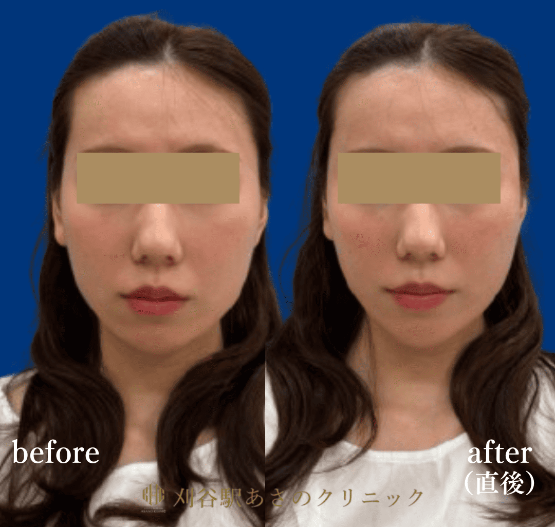 ヒアルロン酸 3cc 症例写真