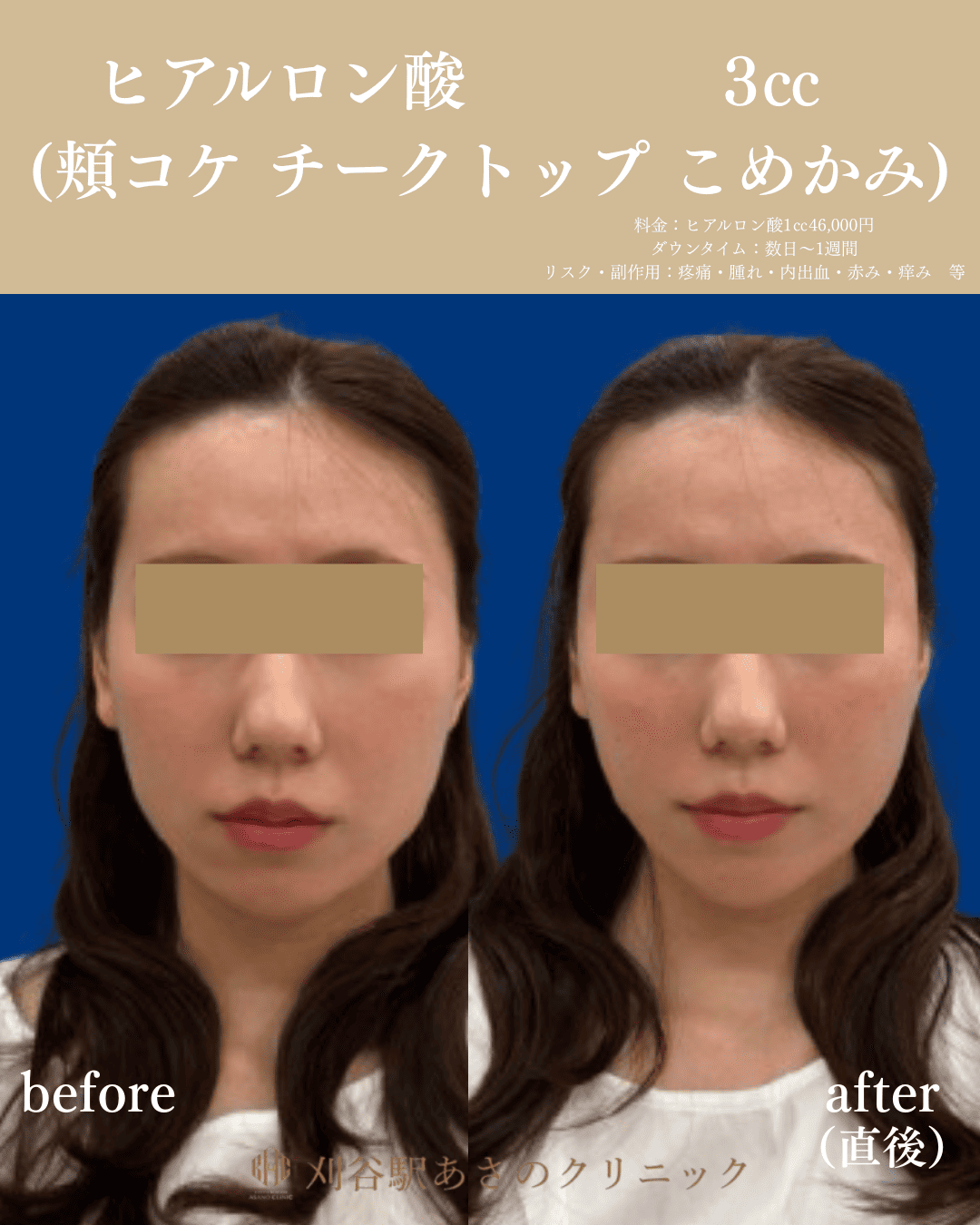 ヒアルロン酸 3cc 症例写真 1