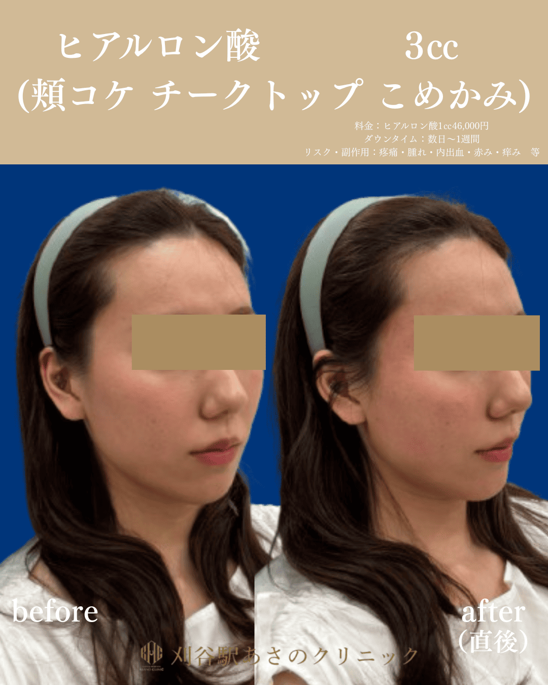 ヒアルロン酸 3cc 症例写真 2