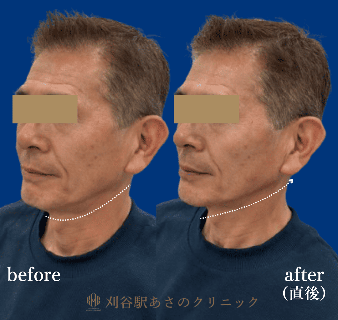 ヒアルロン酸 4cc 症例写真