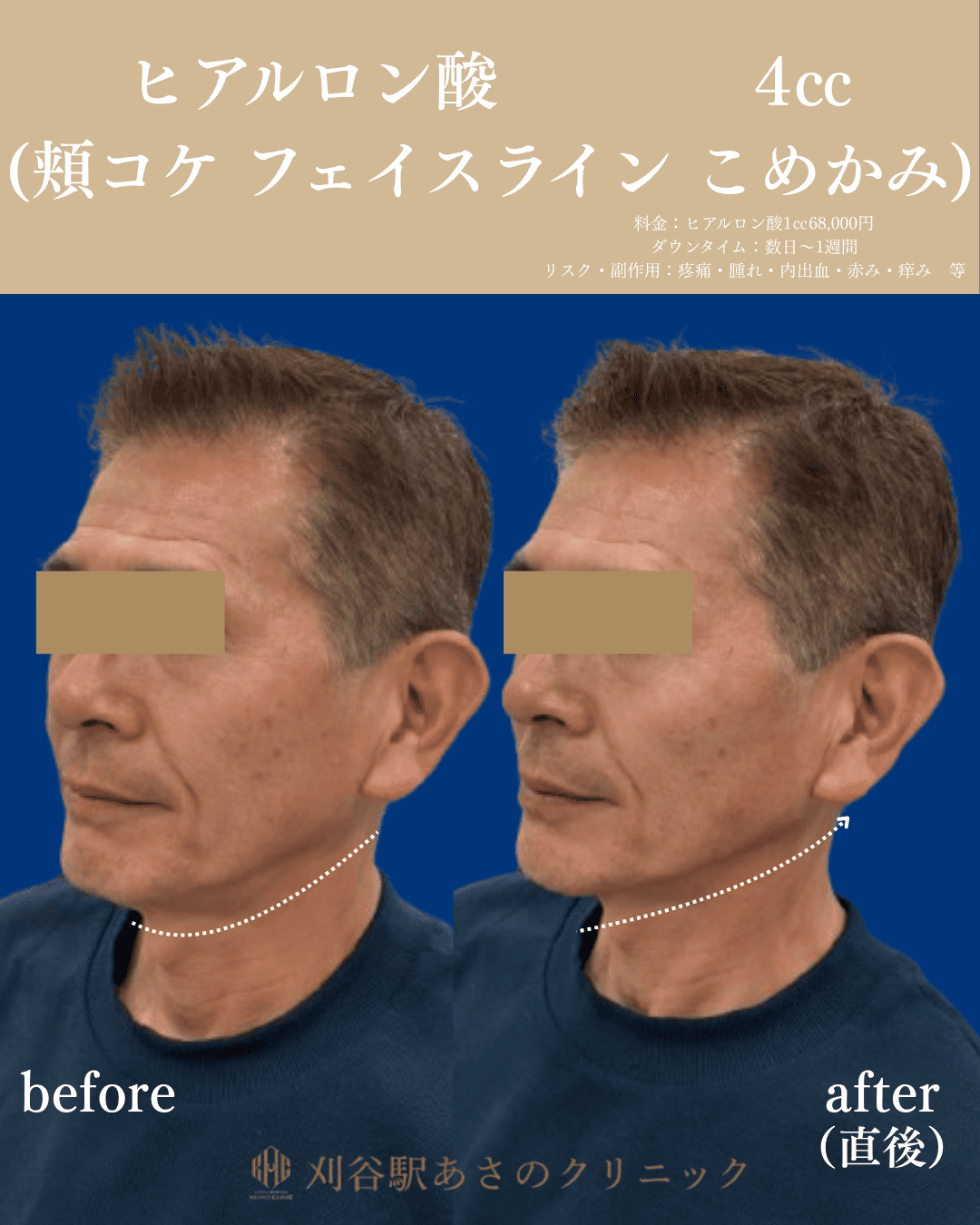 ヒアルロン酸 4cc 症例写真 1