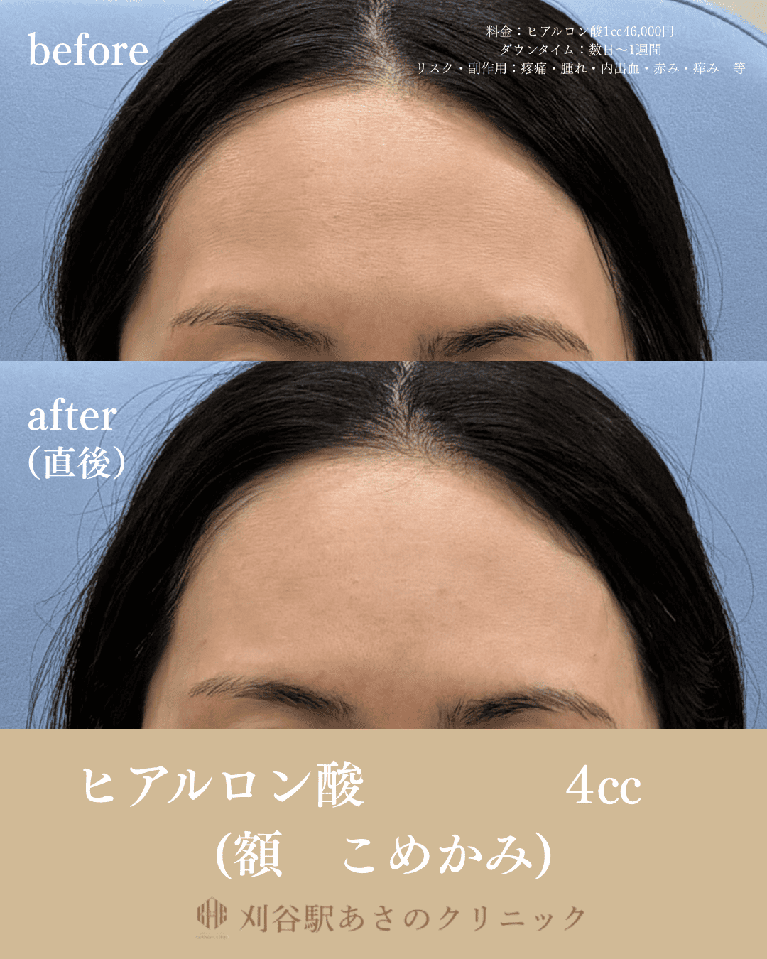 ヒアルロン酸4cc 症例写真 1