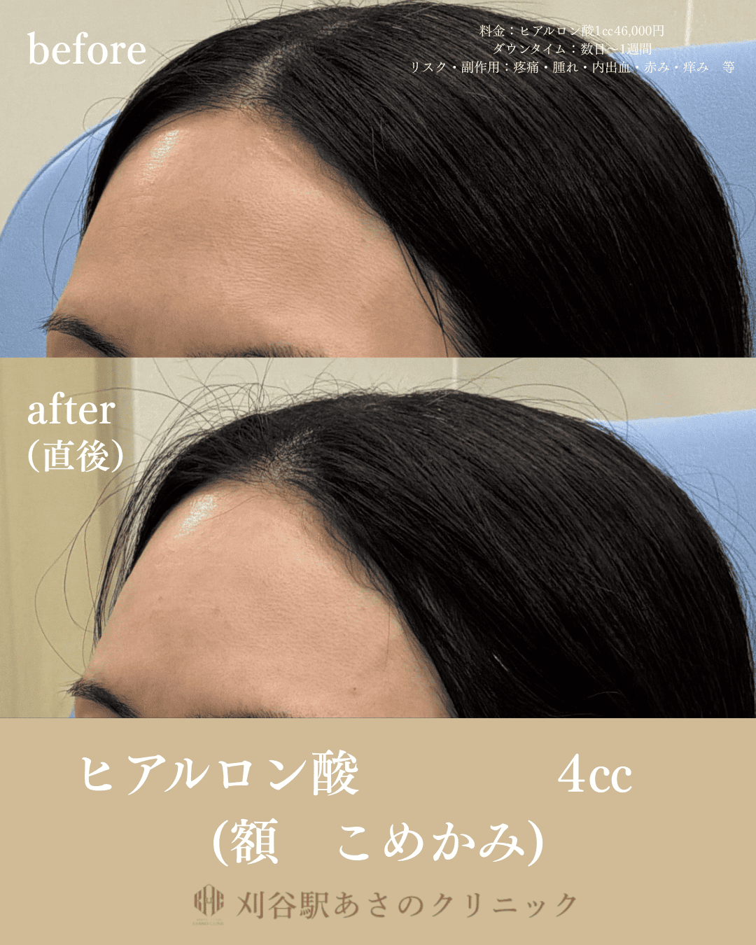 ヒアルロン酸4cc 症例写真 2