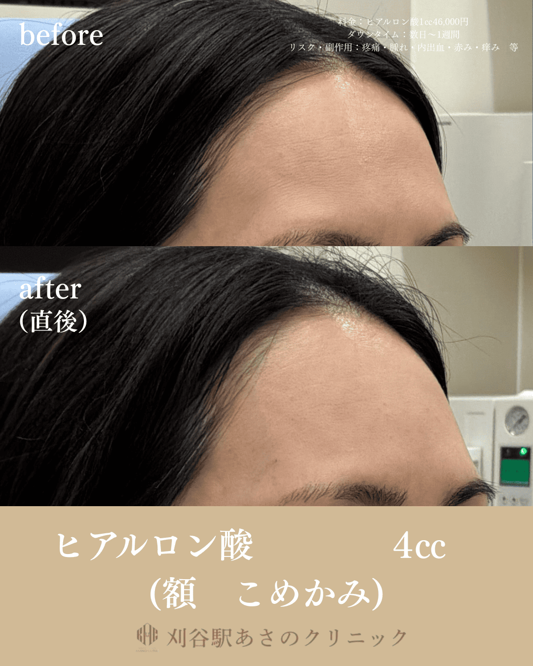 ヒアルロン酸4cc 症例写真 3