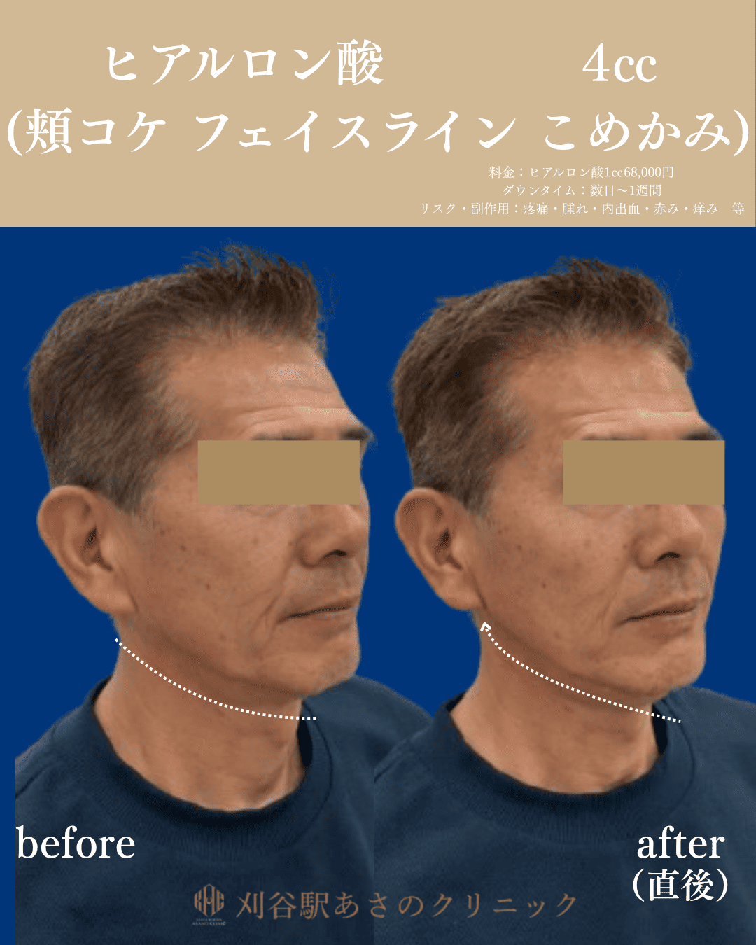 ヒアルロン酸 4cc 症例写真 2