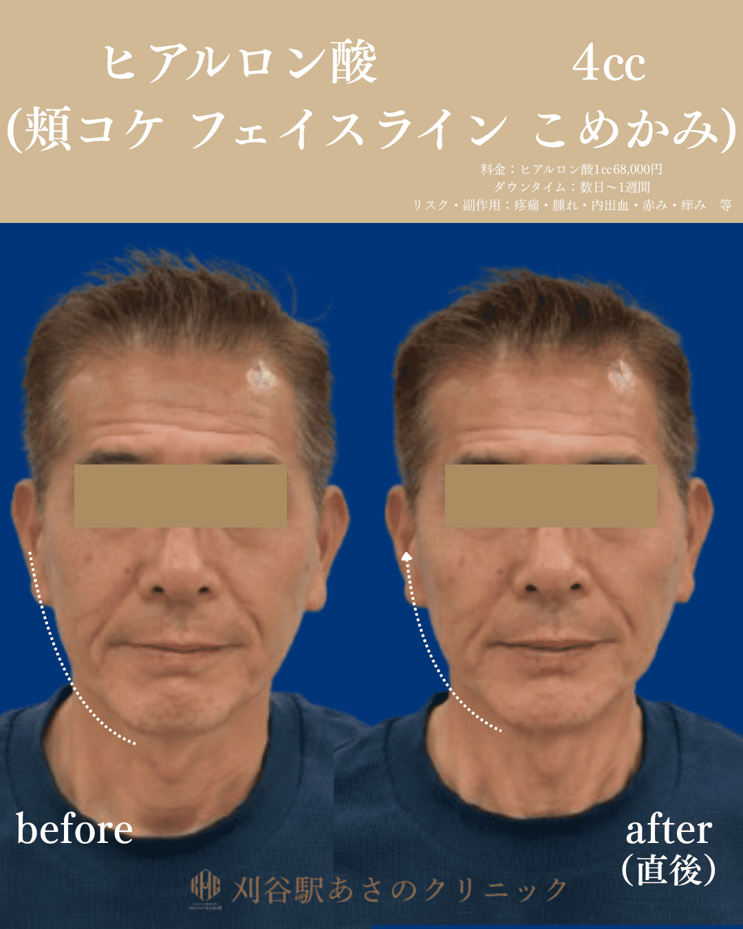 ヒアルロン酸 4cc 症例写真 3