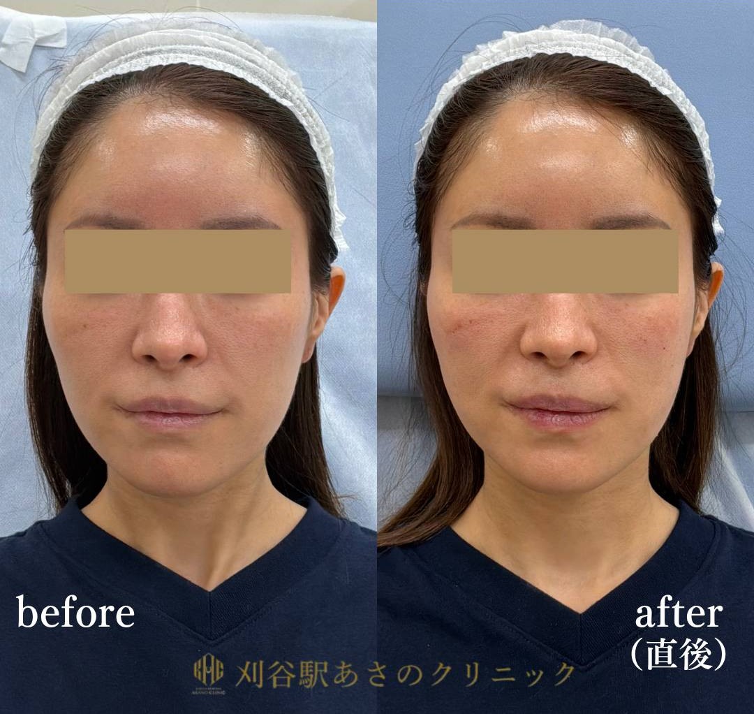 ヒアルロン酸 頬コケ 3cc 症例写真