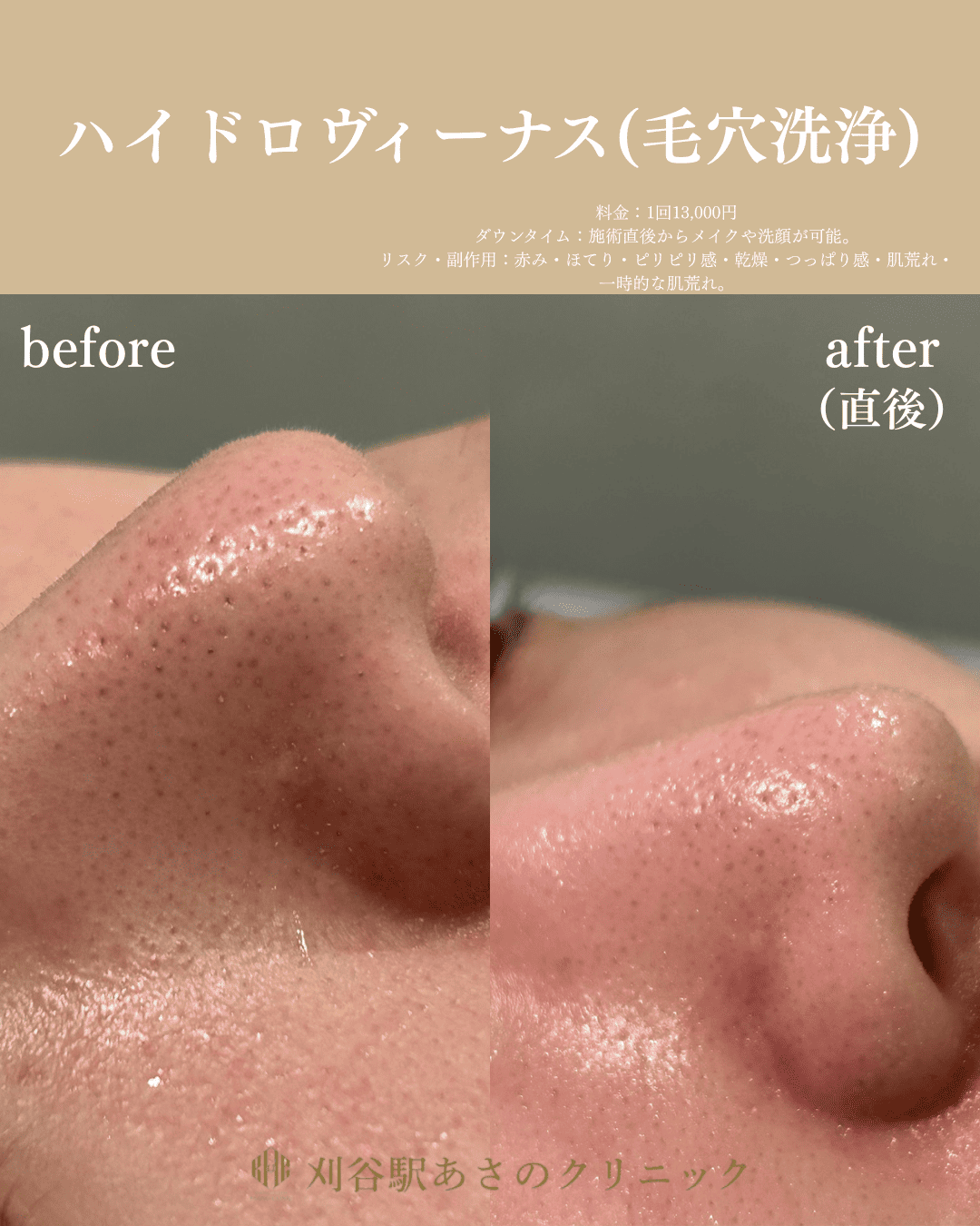 毛穴の開き・黒ずみが気になる｜症例：ハイドロヴィーナス - 刈谷駅
