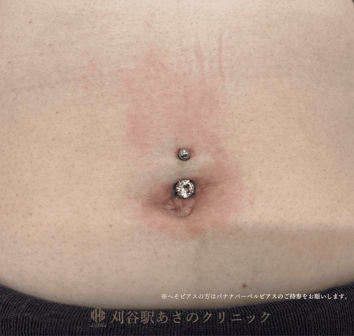 ピアス穴あけ へそ 症例写真