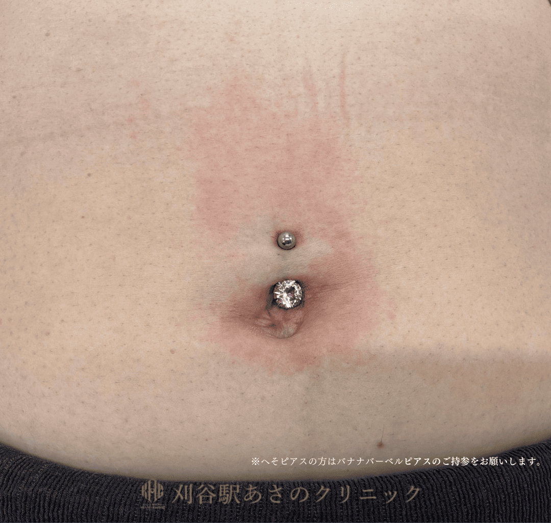 ピアス穴あけ へそ 症例写真