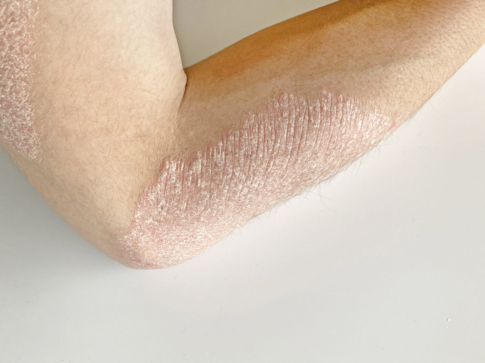 乾癬の皮膚疾患を患った腕