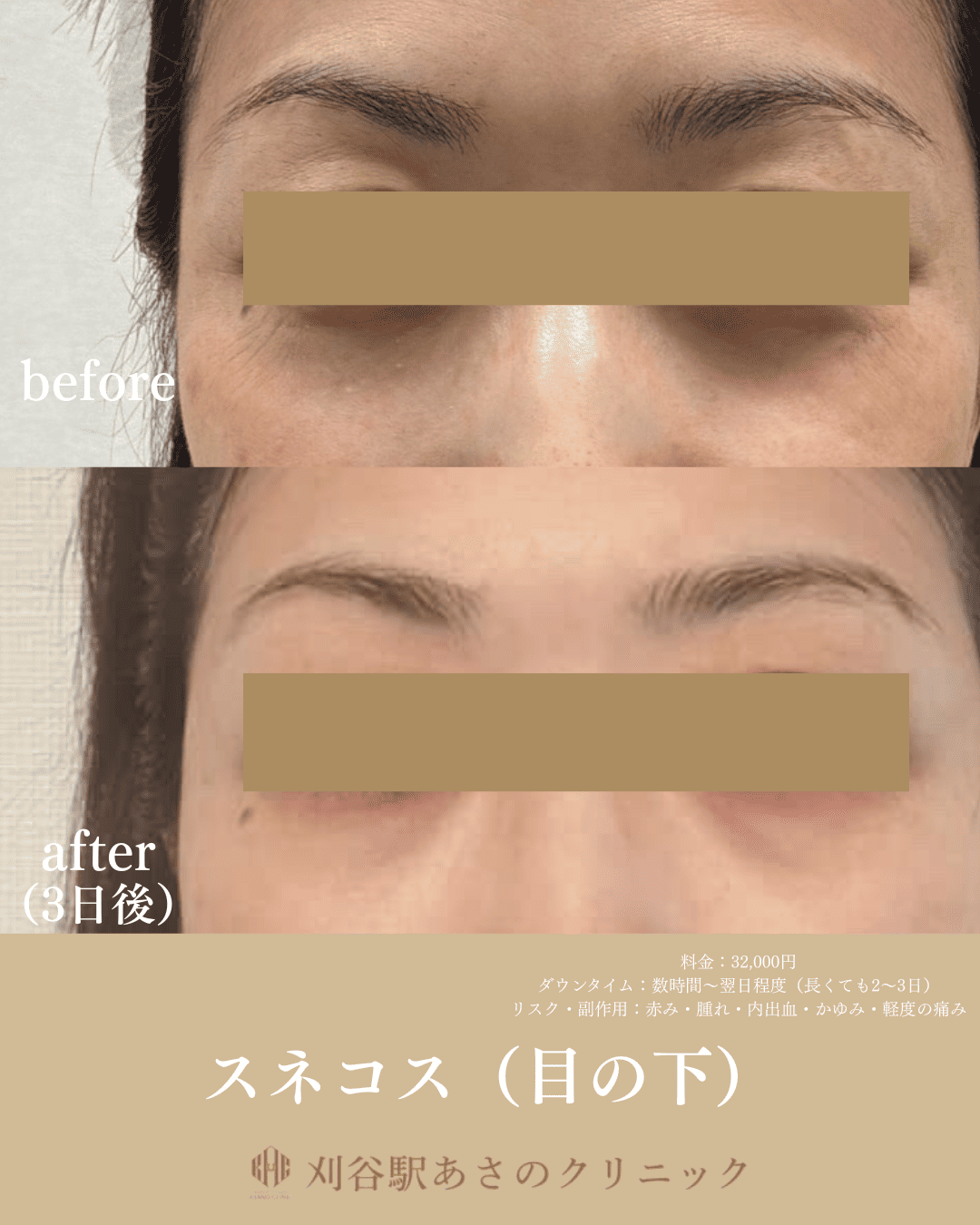 スネコス 目の下 症例写真 1