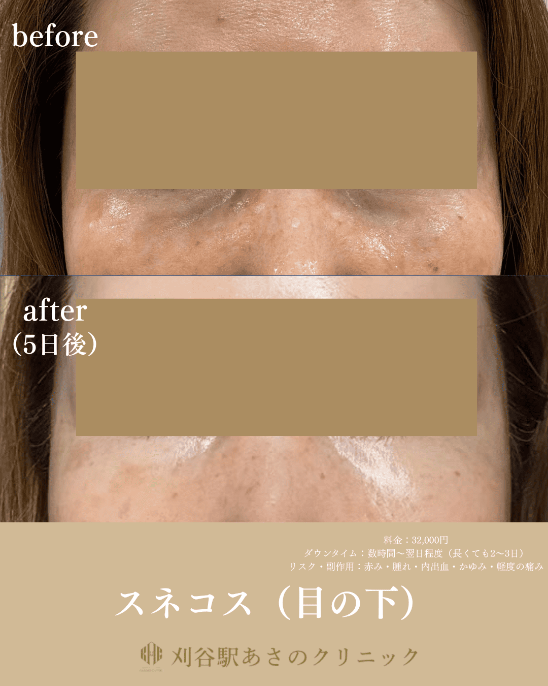 スネコス（目の下） 症例写真 1