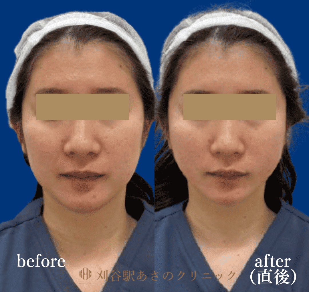 ヴィーナスリフト 症例写真