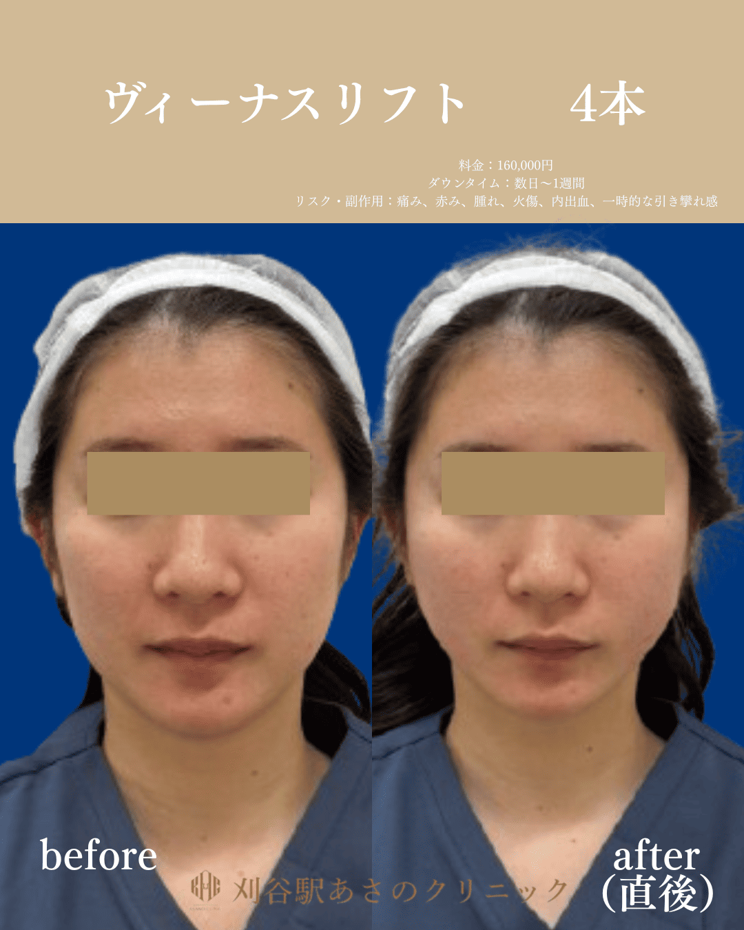 ヴィーナスリフト 症例写真 1