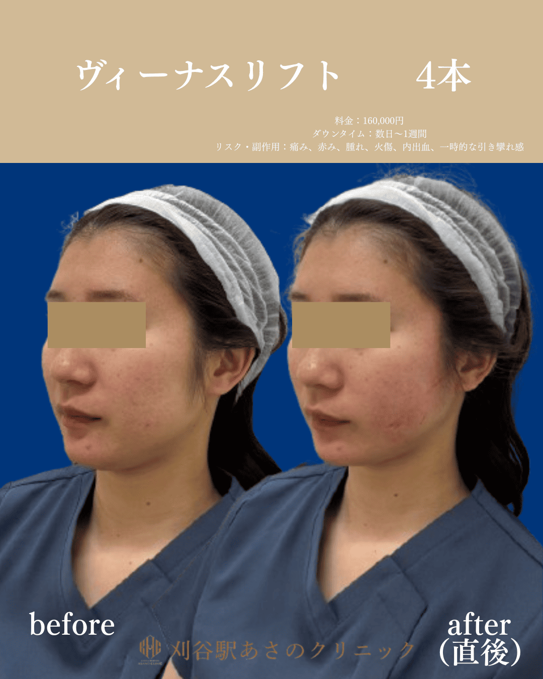 ヴィーナスリフト 症例写真 2
