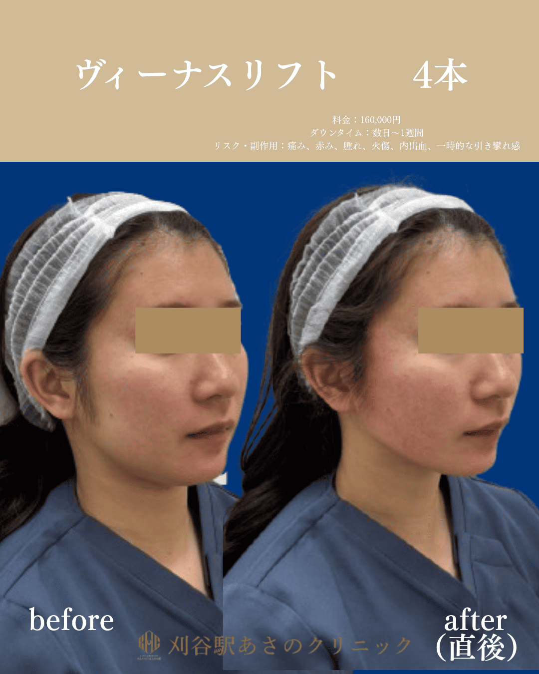 ヴィーナスリフト 症例写真 3