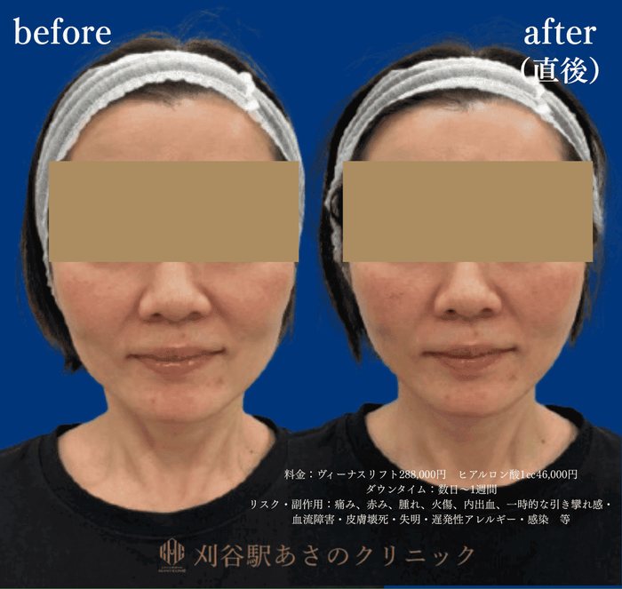 ヴィーナスリフトとヒアルロン酸 症例写真