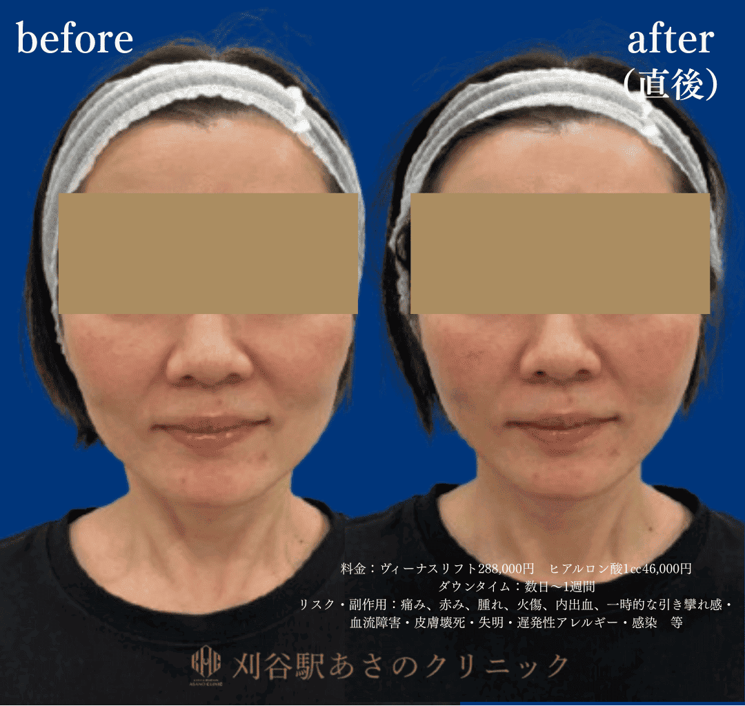 ヴィーナスリフトとヒアルロン酸 症例写真