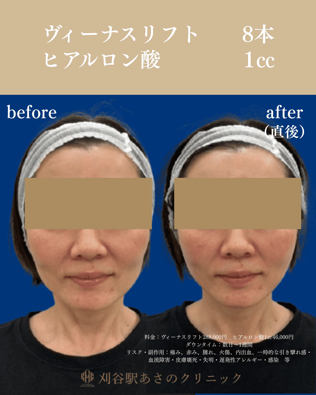 ヴィーナスリフトとヒアルロン酸 症例写真 1