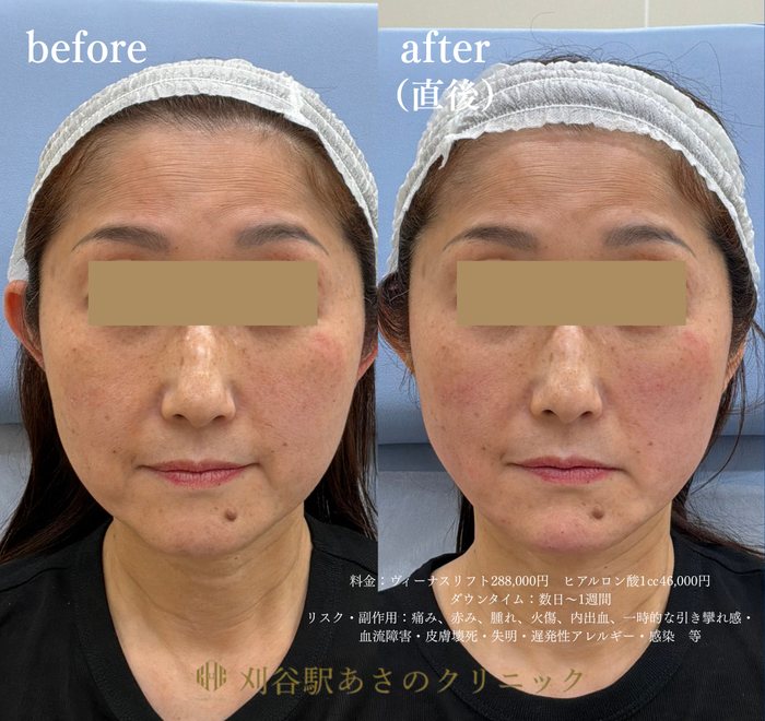 ヴィーナスリフト ヒアルロン酸 症例写真
