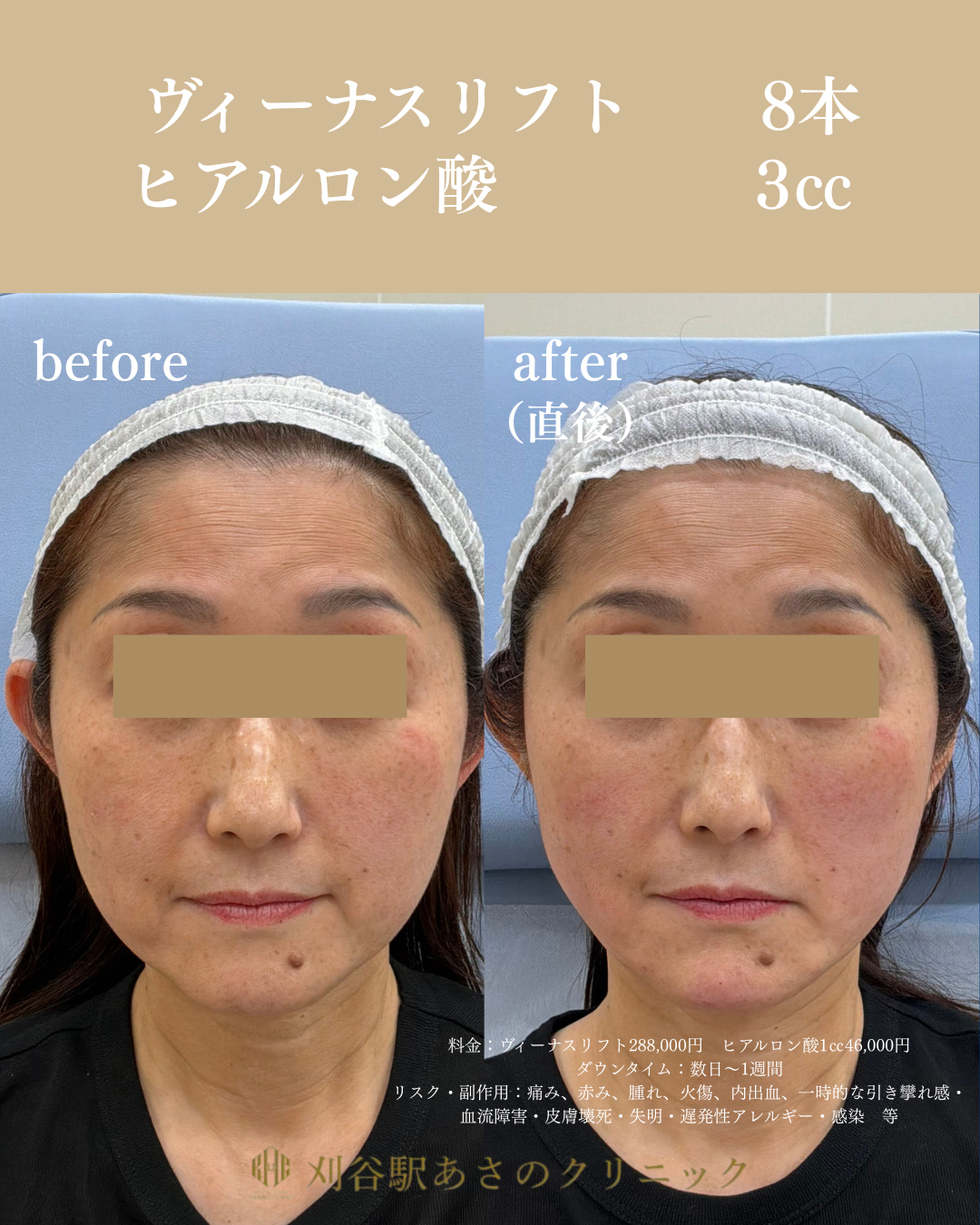 ヴィーナスリフト ヒアルロン酸 症例写真 1