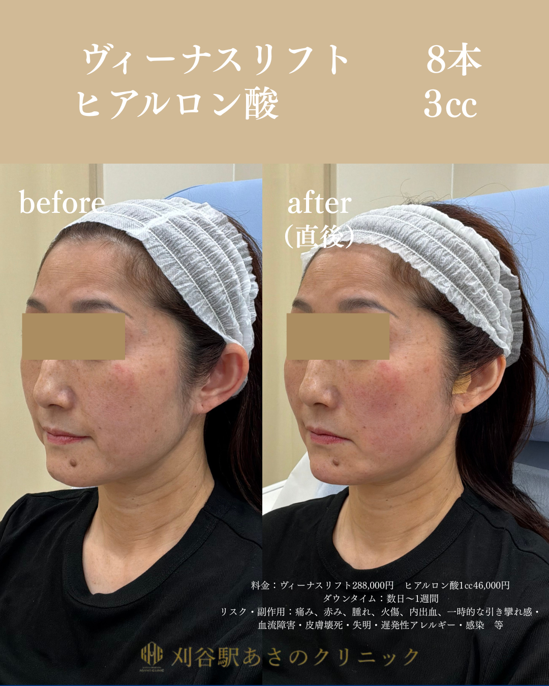 ヴィーナスリフト ヒアルロン酸 症例写真 2