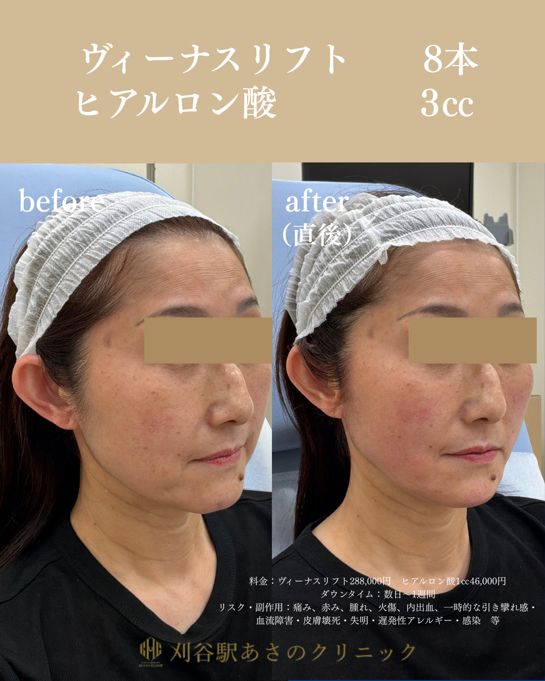 ヴィーナスリフト ヒアルロン酸 症例写真 3