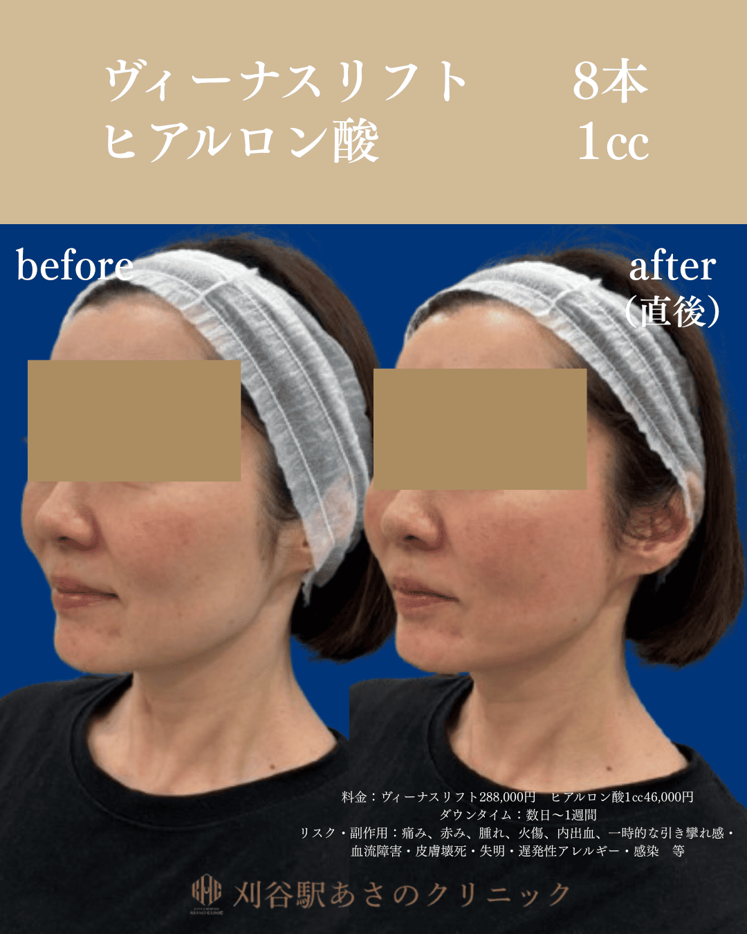 ヴィーナスリフトとヒアルロン酸 症例写真 2