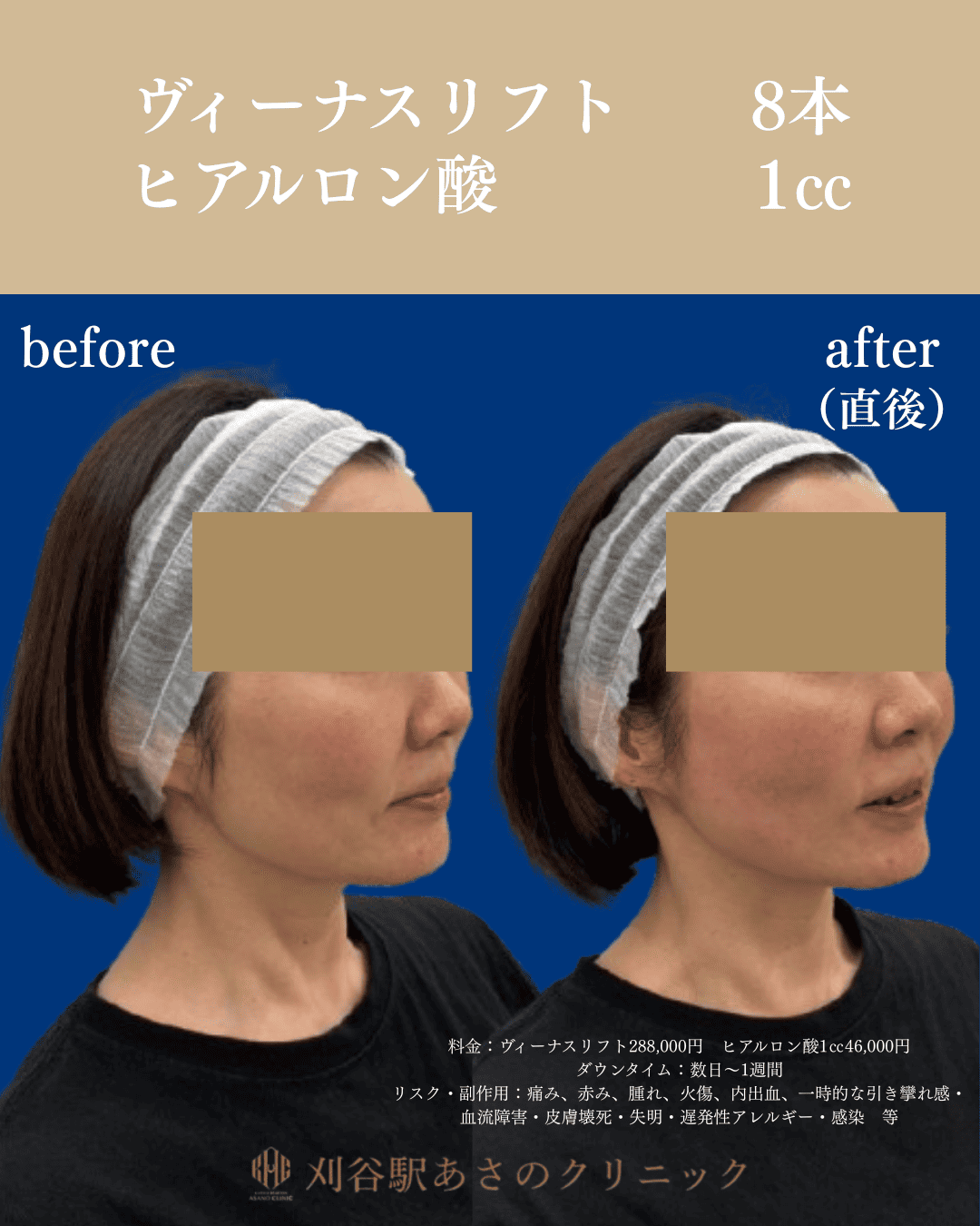 ヴィーナスリフトとヒアルロン酸 症例写真 3